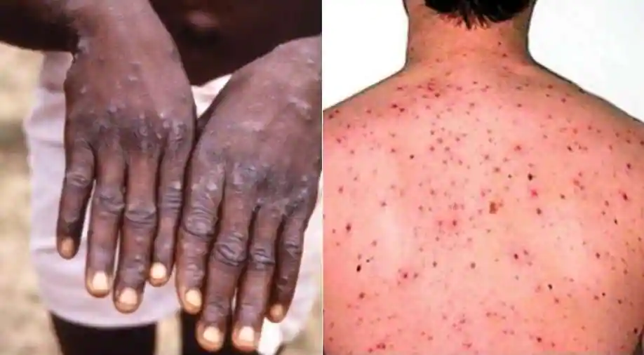 Nigeria daily how to protect yourself against mpox - nigeria newspapers online